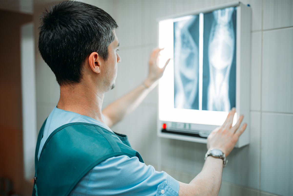 Sans-titre-2 Imagerie médicale d'une personne souffrant d'ostéophytose