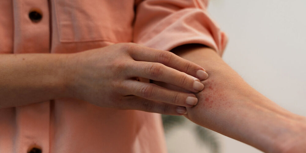 Femme de plus de 65 ans qui a le zona
